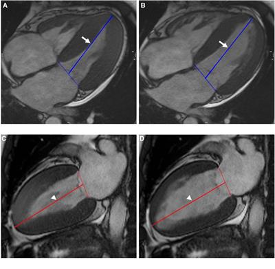 CMR left ventricular strains beyond global longitudinal strain in differentiating light-chain cardiac amyloidosis from hypertrophic cardiomyopathy